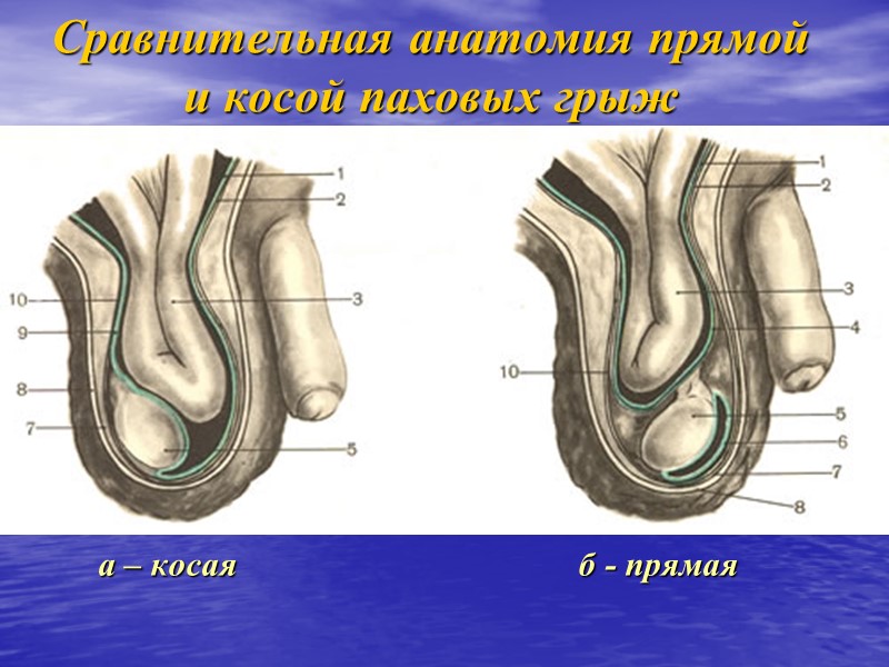 Сравнительная анатомия прямой и косой паховых грыж  а – косая   